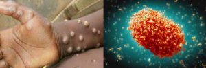 Monkeypox-virus